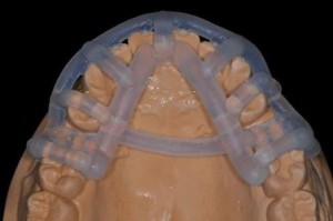 3D printed surgical guide on dental model prior to surgery Image credit: Stratasys/PR Newswire