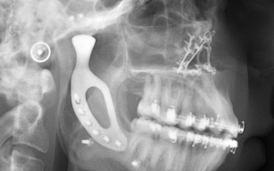 Image credit:http://newsroom.melbourne.edu/news/australia-first-reconstructive-surgery-uses-3d-printed-jaw-implant-0